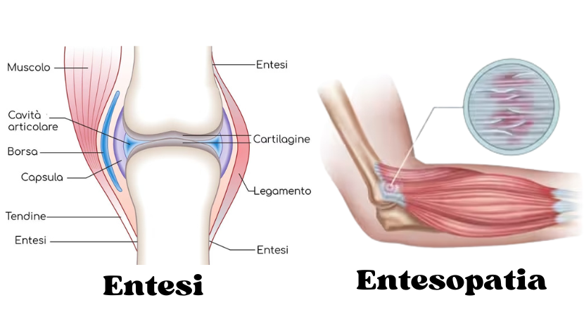 differenza entesi entesopatia